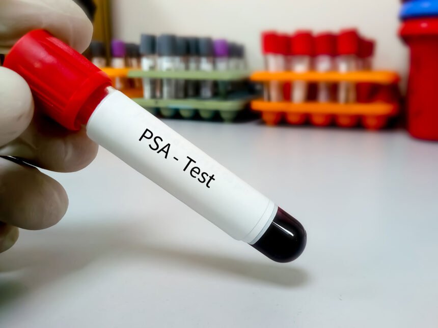 PSA Blood Test