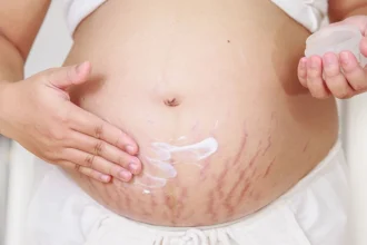 Ways to fade pregnancy stretch marks