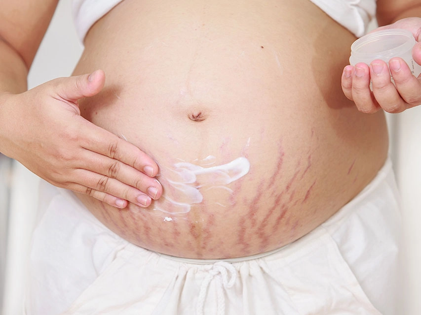 Ways to fade pregnancy stretch marks